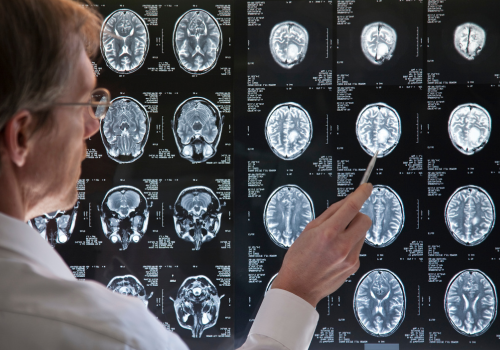 doctor checking an MRI scan of a brain for injuries