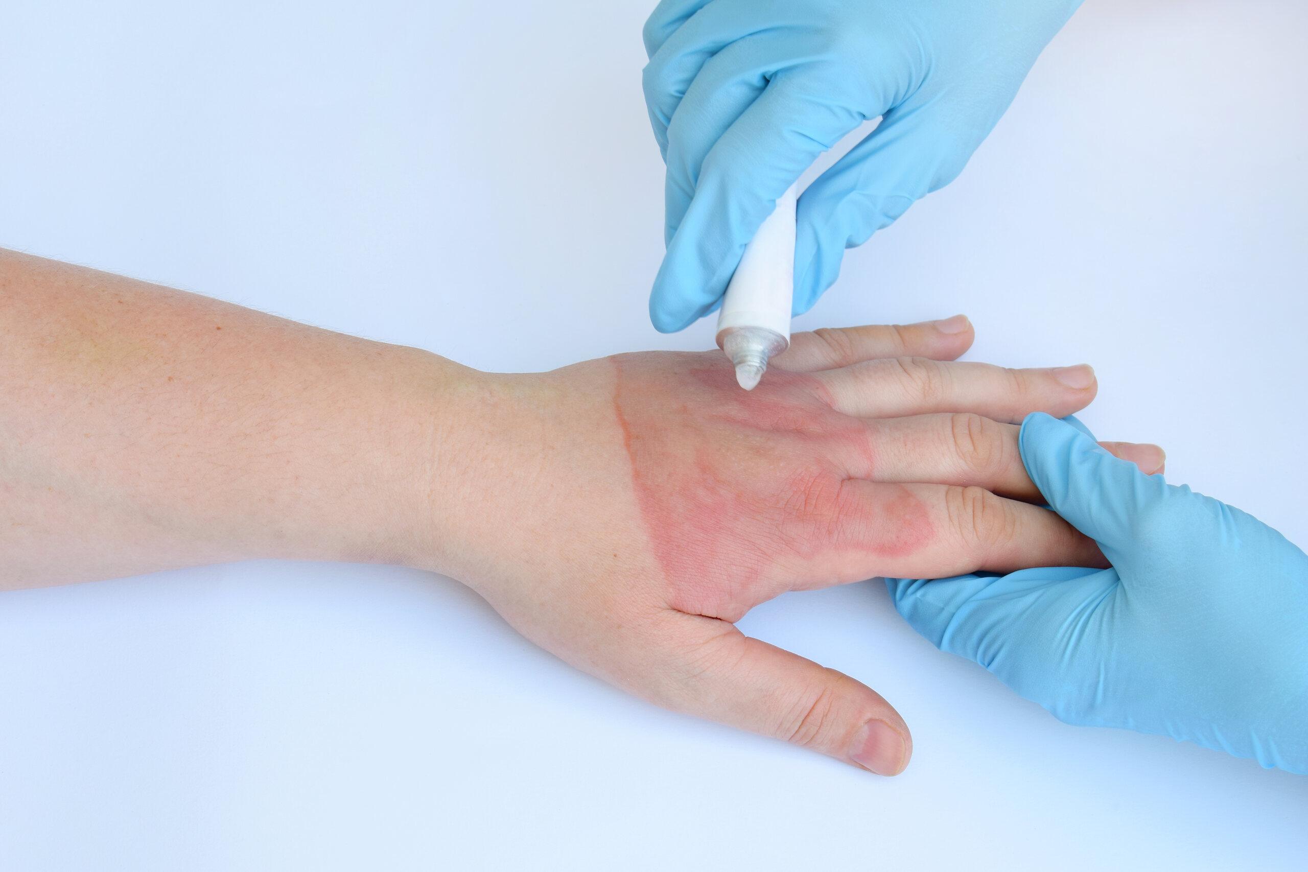 Pensacola Burn Injury Attorneys | Cardoso Law, PLLC